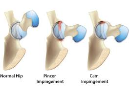 Hip Impingement
